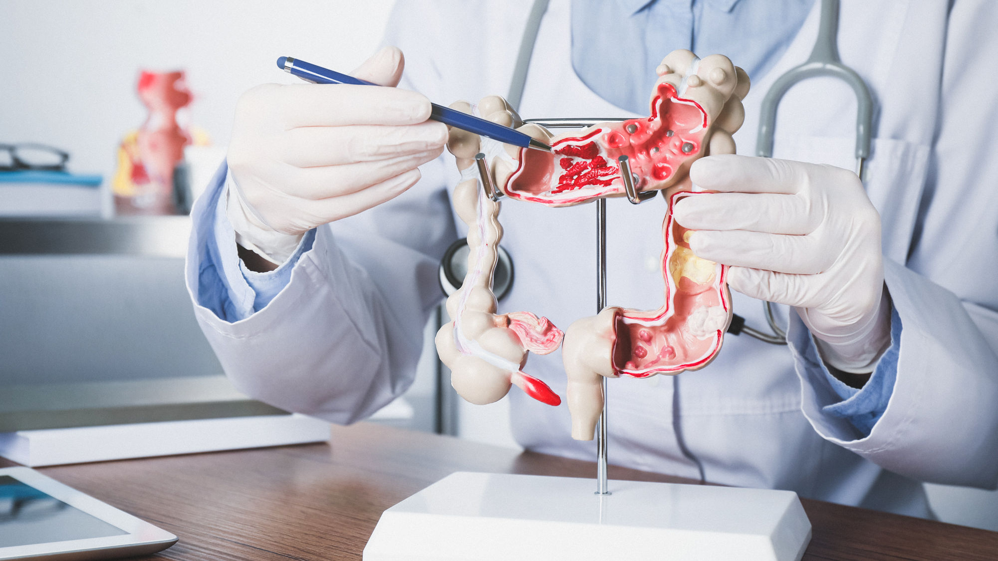 Ärztin erklärt am Modell eines Darmes